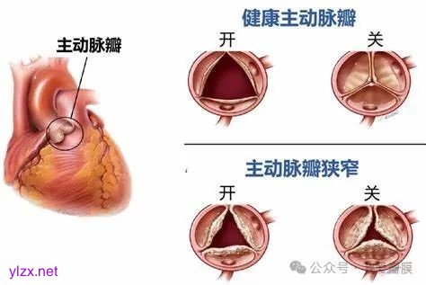 【曙光&middot;动态】我成功实施一例经导管主动脉瓣置换术（TAVR）_澎湃号&middot;政务_澎湃新闻-The Paper